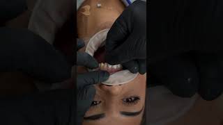 Cementation new veneers dentist viralvideo [upl. by Ahsenor]