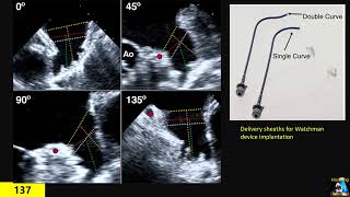 Left Atrial Appendage measurements amp Watchman [upl. by Lraed]