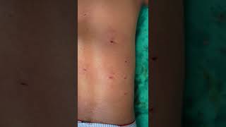 Multiple Lipoma Removal from patient body shortsvideo viralshort [upl. by Ayeka]