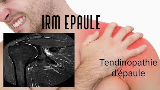 IRM DE L’EPAULE  tendinopathie [upl. by Nynnahs]