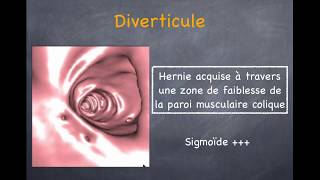 Diverticulose Colique et Sigmoïdite  1 Diverticule diverticulose diverticulite non compliquée [upl. by Neffirg798]