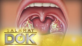 Salamat Dok Information about tonsil stones [upl. by Rednas524]