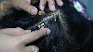 Dandruff scratching removal on head using black combing329 [upl. by Yensehc]