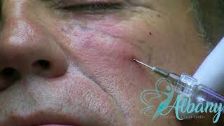 Tear trough filler with microcannula [upl. by Engvall]