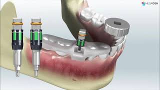 Extraction amp Implant placement with R2 Stent [upl. by Yenttirb]