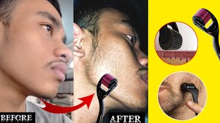 Derma roller for beard  minoxidil beard  derma roller beard growth man matters beard oil review [upl. by Steffane]