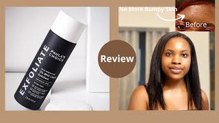 Watch This Before You Buy Paulas Choice 2 BHA Liquid Exfoliant Review ⎪On Oily Acne Prone Skin [upl. by Drews577]