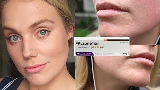 ACZONE DAPSONE GEL 5 REVIEW  Chronic Adult Acne 2 Month Progress 2021 [upl. by Anid731]