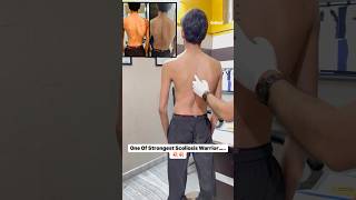 Severe spinal deformity scoliosis treatment by DrRavi scoliosis doctor chiropractor physio [upl. by Kiernan]