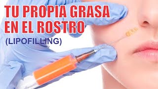 LIPOFILLING o LIPOTRANSFERENCIA al ROSTRO 👸🏻 Tu propia GRASA en el rostro ❤️ Dra LIZBETH ZUÑIGA [upl. by Rexana940]