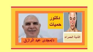 الذئبة الحمراء وأحدث طرق علاجها SYSTEMIC LUPUS ERYTHEMATOSUS [upl. by Abraham]