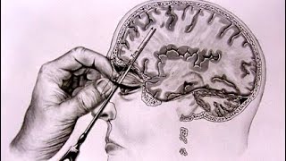 People Before And After Lobotomies… [upl. by Noam]