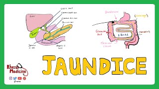 JAUNDICE Differential diagnosis of Jaundice  PrehepaticHepaticPost Hepatic Causes of Jaundice [upl. by Lika191]