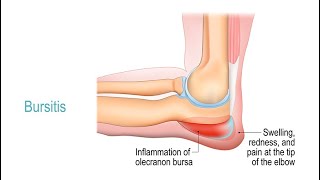 Treating Bursitis [upl. by Alekahs291]