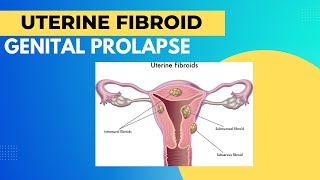 Uterine fibroid l Genital prolapse l causes l symptoms l treatment l Gynaecology bamslectures [upl. by Ainessey]