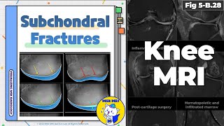 Fig 5B28 Four Types of Subchondral Insufficiency Fractures [upl. by Folger723]