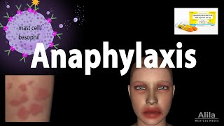 Anaphylaxis Animation [upl. by Koral]