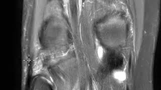 Popliteus tendon tear [upl. by Netsruk916]