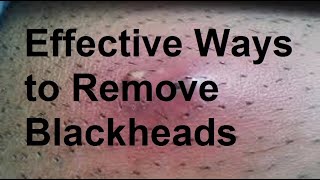 Effective Ways to Remove Blackheads [upl. by Candice48]