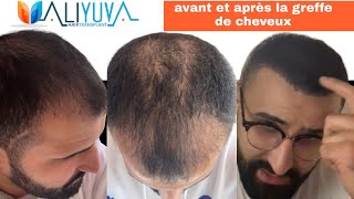 Expérience avant et après la greffe de cheveux à Istanbul Turquie [upl. by Ainek903]