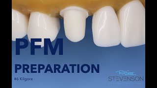 PFM Preparation on The Canine Tooth 6 Kilgore  Stevenson Dental Solutions [upl. by Annehsat]