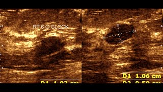 Fibroadenoma Breast  Breast Tumor  Benign Breast Tumor [upl. by Lobel]