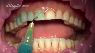 Prepless Veneers Permanent Teeth Whitening [upl. by Ahseuqram]