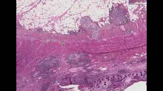 Histopathology Small intestine Crohn disease [upl. by Eejan59]