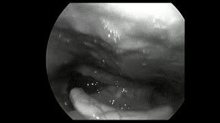 Video laryngoscopy showing Intra Epithelial Cell Carcinoma of Larynx [upl. by Aniham]