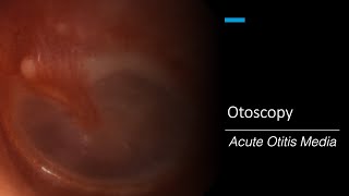 Acute Otitis Media Otoscopy [upl. by Mcmath731]