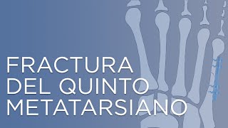 Fractura del quinto metatarsiano  IQTRA [upl. by Atterrol]