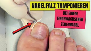 Nagel tamponieren bei EINGEWACHSENEN NÄGELN  Eingewachsene Nägel endlich loswerden [upl. by Tj]