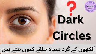 Dark Circles  Periorbital Hyperpigmentation  Black Circles  Eye Shadow  Eyesight Eye Healthcare [upl. by Ramoj]