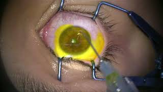 Corneal Collagen Cross Linking for Keratoconus [upl. by Sarajane]