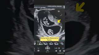 “Key Ultrasound Findings in Dichorionic Diamniotic Twins” [upl. by Buff]