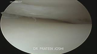 MCL PieCrusting to open up medial compartment knee for Meniscus Repair  Dr Prateek Joshi [upl. by Mapes660]