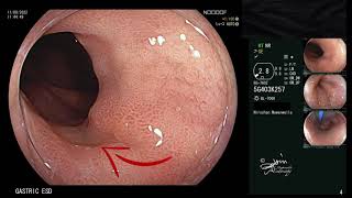 ESD of Early Gastric Cancer in the Cardia [upl. by Irvin956]