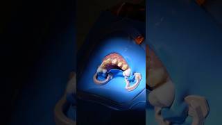 Cementation of 6 front upper veneers Viral Video DentalTourism Cancun [upl. by Antrim]