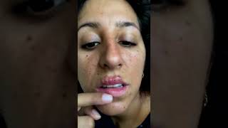 Cystic acne and blackheads removal  Newest pimple pops for 2022 [upl. by Jobye]