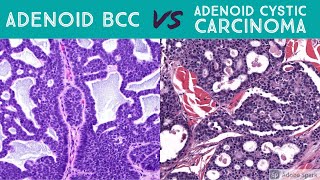 Cutaneous Adenoid Cystic Carcinoma vs Adenoid Basal Cell Carcinoma Dermpath Dermatology Pathology [upl. by Mathews]