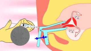 Intrauterine insemination IUI videoflv about infertility and ivf treatment [upl. by Hilliard164]