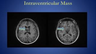 Intracranial Mass Lesions Version 1 0 [upl. by Eloci]