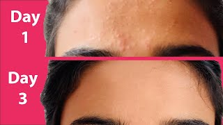 ACNE Treatment At Home  3 day Acne REMOVAL Challenge  Acne Treatment Ayurvedic with Results [upl. by Arrim270]