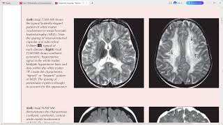 PAEDIATRIC NEURORADIOLOGY DIAGNOSTIC IMAGING [upl. by Ecerehs]