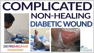 Complicated Nonhealing Diabetic wound  Dr Prems Diabetic Foot  Podiatrist Chennai [upl. by Einaeg]