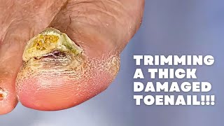 Trimming a THICK DAMAGED Toenail [upl. by Nonnahs]