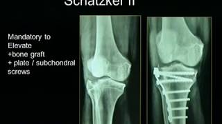 Tibial Plateau Fractures [upl. by Gintz]