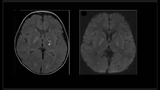 Basal Ganglia Lesions  Part 2 [upl. by Lednam466]