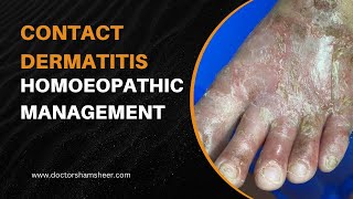 Contact dermatitis [upl. by Marva439]