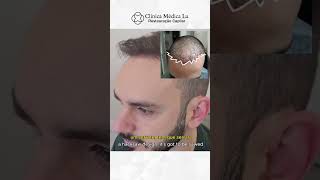 Paciente com cabelo fino  Resultado surpreendente transplantecapilar drpaulolu hairtransplant [upl. by Higgs]